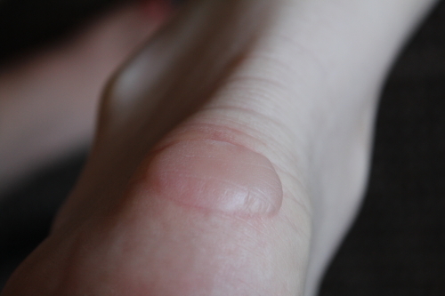 Badly blistered foot 